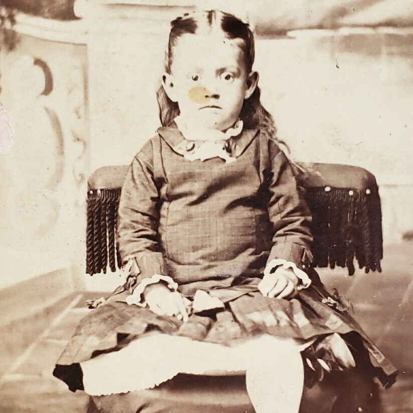 Down Syndrome Girl CDV Photo c1865 Columbia City Indiana Child Antique IN A2189