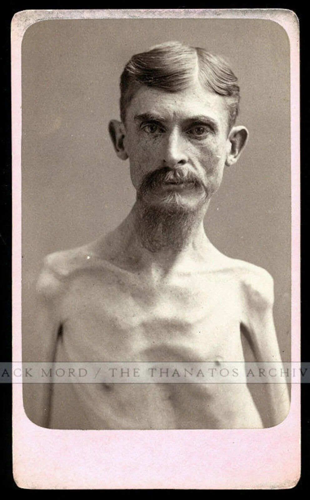 Extremely Rare Sideshow Freak Photo Skeleton Man Possibly OOAK Eisenmann Test