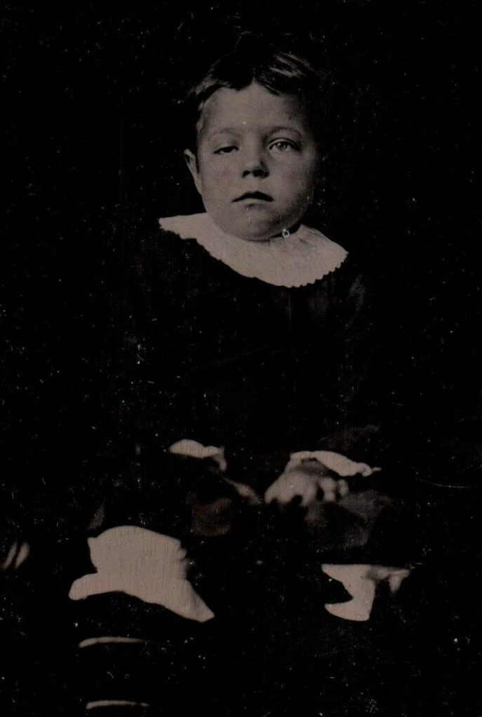 Antique Tintype Photo of Disabled Child with Deformed Eye