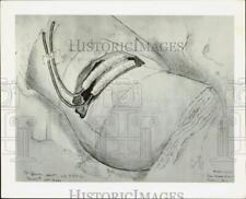 1918 Press Photo Artist's drawing of a hip injury suffered by WWI soldier picture