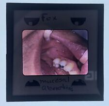 Weird Strange Bizarre Medical Dental Glass Color Slide ULCERATIONS Mouth Tongue picture