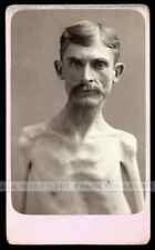 Extremely Rare Sideshow Freak Photo Skeleton Man Possibly OOAK Eisenmann Test picture